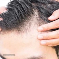 کاشت مو به روش HRT - مرکز تخصصی مو اهورا 