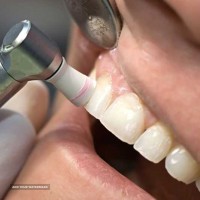 جرم گیری و بروساژ دندان 