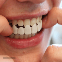 انجام انواع پروتز دندان با بهترین کیفیت 