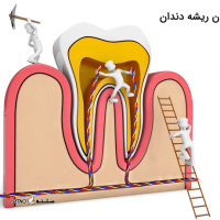 درمان ریشه دندان بدون درد و تروما / درچه ، خمینی شهر ، اصفهان