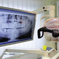 رادیوگرافی دیجیتال دندان در اصفهان / درچه