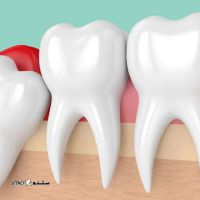 جراحی دندان عقل در درچه  کشیدن دندان در خمینی شهر