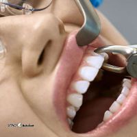 کشیدن+دندان+دندانپزشکی+درچه