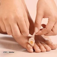 Treatment-of-corns-with-glue