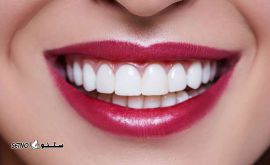 قیمت لمینت دندان / خیابان توحید / اصفهان 