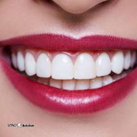 قیمت لمینت دندان / خیابان توحید / اصفهان 