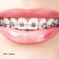 هزینه ارتودنسی در اصفهان / خیابان توحید