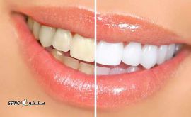 بلیچینگ دندان / اصفهان