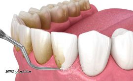 جرم گیری دندان / دکتر ریاحی