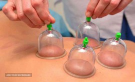 حجامت-بادکش