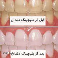 بلیچینگ دندان دکتر ریاحی