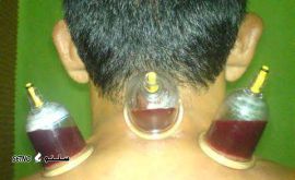 Cupping-photos-aks-hejamat-17