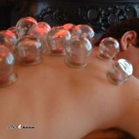 Cupping-photos-aks-hejamat-28