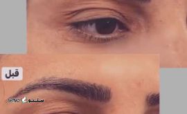 d33a8460-c32f-11ee-a5da-55096b171caeبوتاکس