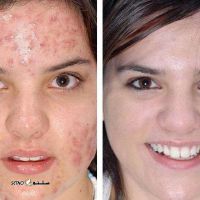 nody-عکس-پاکسازی-صورت-قبل-و-بعد-1631264731