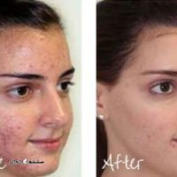 میکرودرم-ابریژن-پوست