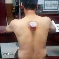 images (3)حجامت