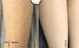 عکس قبل و بعد لیزر