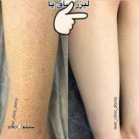 عکس قبل و بعد لیزر