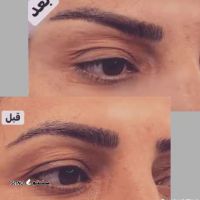 d33a8460-c32f-11ee-a5da-55096b171caeبوتاکس